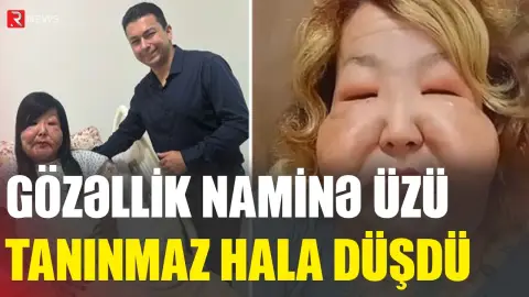 Gözəllik naminə üzü tanınmaz hala düşdü - RTV