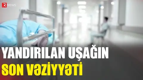 Yandırılan uşağın son vəziyyəti açıqlandı - RTV